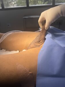 Pós operatório escrotoplastia